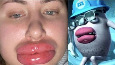 monster inc labios grandes|Joven termina pareciendo a un personaje de Monsters Inc tras。